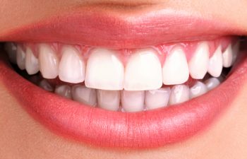 Teeth after whitening