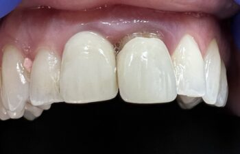 dental implant Before